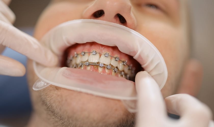 Reach Your Dream Smile: Advantages of Orthodontic Remedy for Anchorage Citizens of All Ages